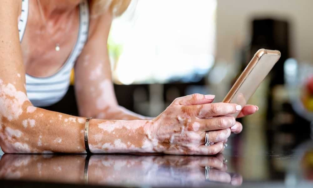 Blonde woman with vitiligo using smartphone